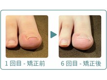巻き爪研究所 表参道院/ホチキス型の巻き爪も矯正可能