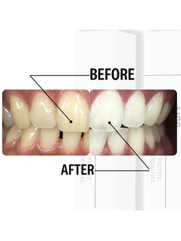 ルナベル(Luna Bell)/ハイパワーホワイトニング