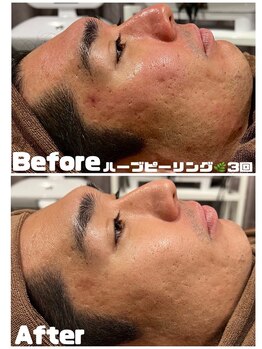 アムールドゥ 麻布十番(Amour deux)/ハーブピーリング3回