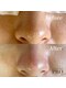 ミナトア(MINATOA)の写真/【廿日市/大野浦駅徒歩2分】毛穴プロが叶える本気の美肌改善☆二人三脚で年齢に負けない肌を目指しましょう