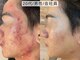 ハナコ 下通店(HANAKO)の写真/『何から始めていいかわからない』『明日の予定前に肌状態を整えたい』そんなあなたへ。