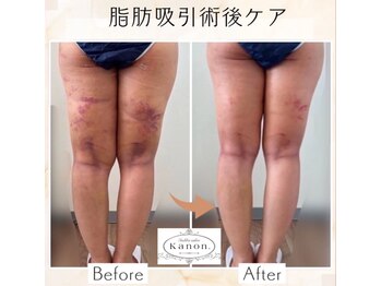 カノン(Kanon.)の写真/完全個室のプライベート空間でインディバを。術後ケアの相談も寄り添いサポートします☆