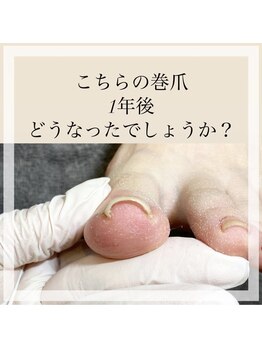 イオネイル(io nail)/巻爪ケア