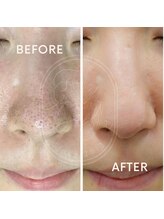 肌屋(HADA-YA)/毛穴リメイク+水光セル