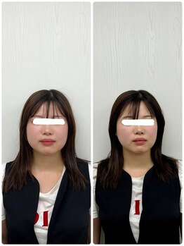 ラフテル鍼灸整骨院/小顔×美容鍼でシャープな小顔に