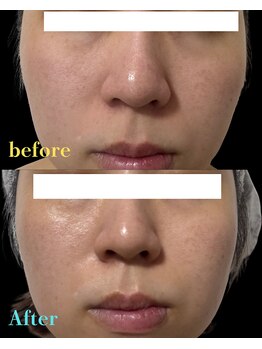 ノエル(Noel)/セラピール施術直後の変化