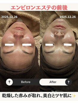 リマイン(Re mine)/エステ直後のビフォーアフター