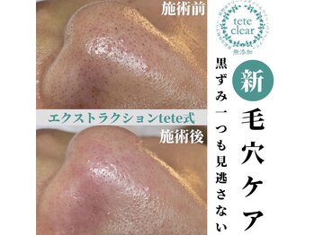 アイシェリー(eyecherie)/毛穴エクストラクション