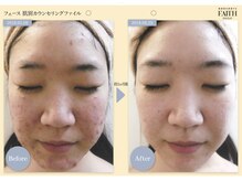ザ フェース 梅田店(THE FAITH)/◆お肌変化写真◆