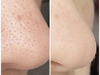 ニコ アンド キャンディー(Nico.&Candy)/取れた汚れもしっかり確認！