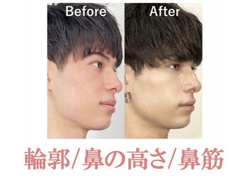 ラプリ 浜松店(Raplit)/ 隆鼻＋輪郭矯正40分30回