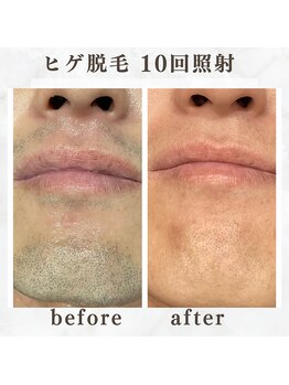 ボゴス(BOGOSS)/ヒゲ脱毛10回照射