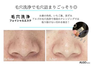 アルゴ 吹田千里山駅前店(ALGO)/【毛穴洗浄】イチゴ鼻卒業!