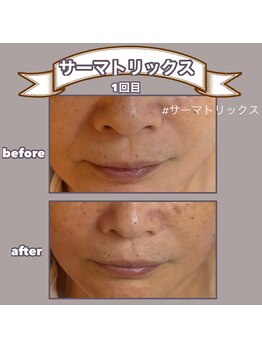 ビーマジック(美magic)/サーマトリックス