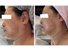 アルページュ(Arpege)/チタニウムで小顔＆首長族