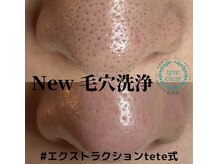 アイシェリー(eyecherie)/毛穴エクストラクション