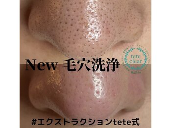 アイシェリー(eyecherie)/毛穴エクストラクション