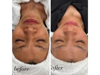 ミノア 大野城店(MINOA)/毛穴・シミケアハーブピーリング