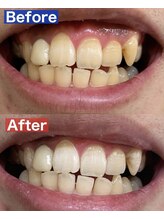 ビューティーグロウ(BEAUTY-GROW)/ホワイトニング