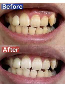 ビューティーグロウ(BEAUTY-GROW)/ホワイトニング