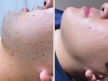 ビクトリー(VICTORY)/メンズ　ヒゲ脱毛