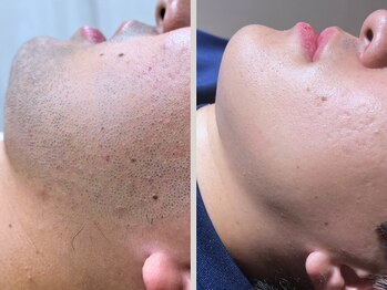 ビクトリー(VICTORY)/メンズ　ヒゲ脱毛