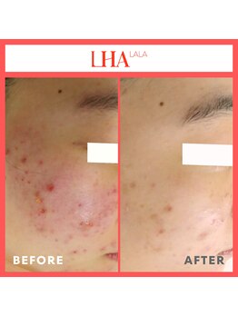 エターナル(Eternal)/ララピールの施術でお悩み解決☆