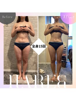 ハレアンド(Hare&)/全身痩身15回目Beforeafter