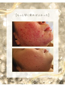 スノースキン(Snow skin)/ニキビケア/ハーブピーリング