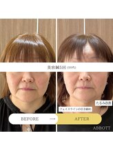 アボット(ABBOTT)/美容鍼5回　50代