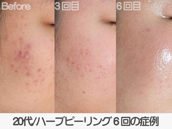 ラ コケット(La Coquette)/ニキビケア色々試していた