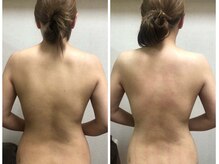 アロマリエ(al malie)/背中ハミ肉ケア！ブライダル