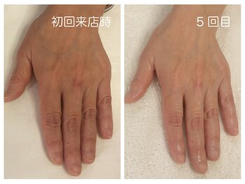 キレイテ 福岡天神店/40代/5回目【福岡ハンドケア】