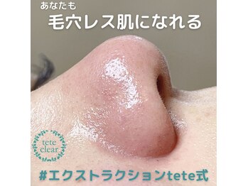 アイシェリー(eyecherie)/毛穴エクストラクション