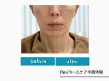 ハピネスビューティーサロン(happiness beauty salon)/ホームケア半顔ビフォーアフター
