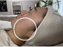 ミーミドットアイ(Mi-mi.i)/before★もみあげフェイスライン