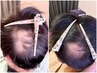 【頭皮のグリーンピール】育毛促進 & 白髪