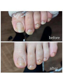 爪切り屋 足楽/【爪肥厚】