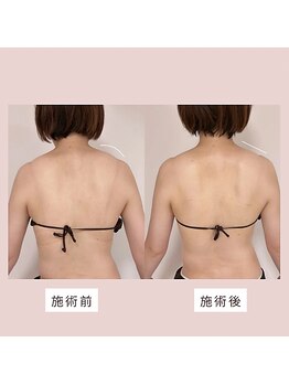 ミーティス/猫背改善