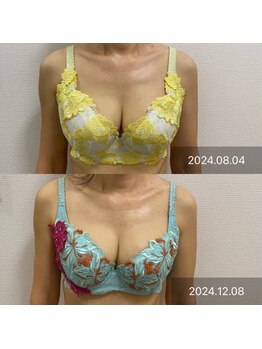 ルミエール(Lumiere)/【倉敷市】バストアップ施術事例