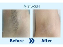 ストラッシュ 大宮店(STLASSH)/【ストラッシュ】お客様の施術例