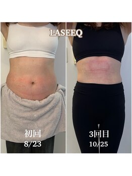 ラシーク(LASEEQ)/お腹の脂肪冷却3回目のお客様