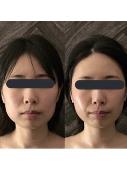 ハイコガオ 中崎町店(HIKOGAO)/小顔矯正