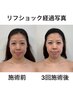 本気の小顔計画！リフショック3回モニター ￥15,000