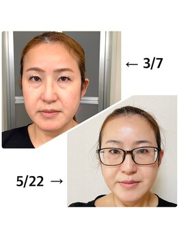 ソフィアアイズ 倉敷店(SOPHIAEYES)/VOSサロンケアでの変化