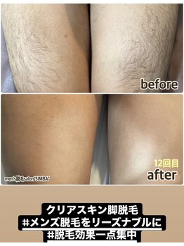 シンバ 倉敷店(SIMBA)/クリアスキン脚脱毛