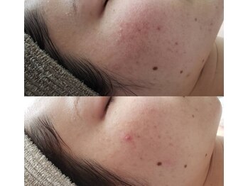 プシュケ(Psyche)/お客様の肌変化