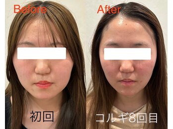 ビーキュート 学芸大学店(BE-CUTE)/Before/After 施術
