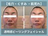 【5月限定】毛穴・くすみリセット｜ピーリングフェイシャル100分 3,500円