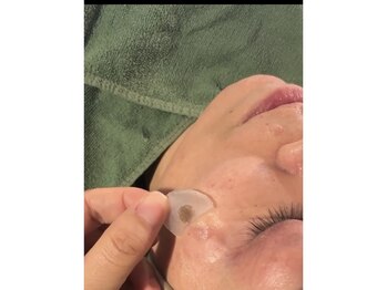 小町ビューティラボ(BeautyLabo)の写真/SNSで話題の次世代シミケア技術☆期間限定モニター価格開始!